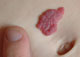 haemangioma